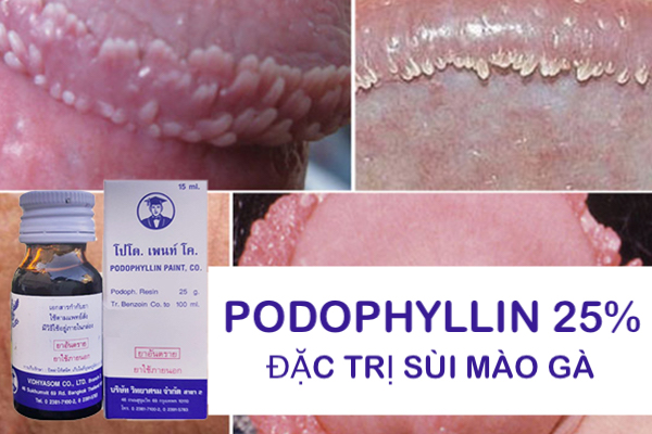 Mua Thuốc Podophyllin 25 Thái Lan chữa trị sùi mào gà tại nhà cho nam nữ hàng xách tay Mua Thuốc Podophyllin 25 Thái Lan chữa trị sùi mào gà tại nhà cho nam nữ hàng xách tay